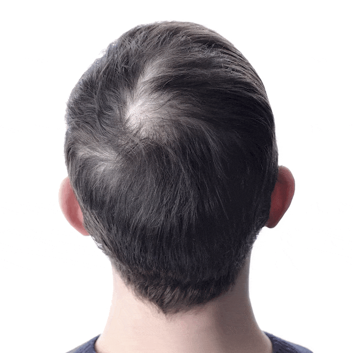 Hair regrowth before and after 30 days